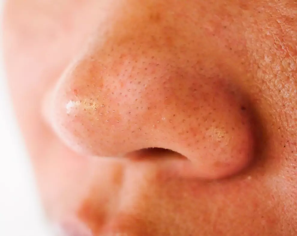 ¿Cómo quitar puntos negros de la nariz?