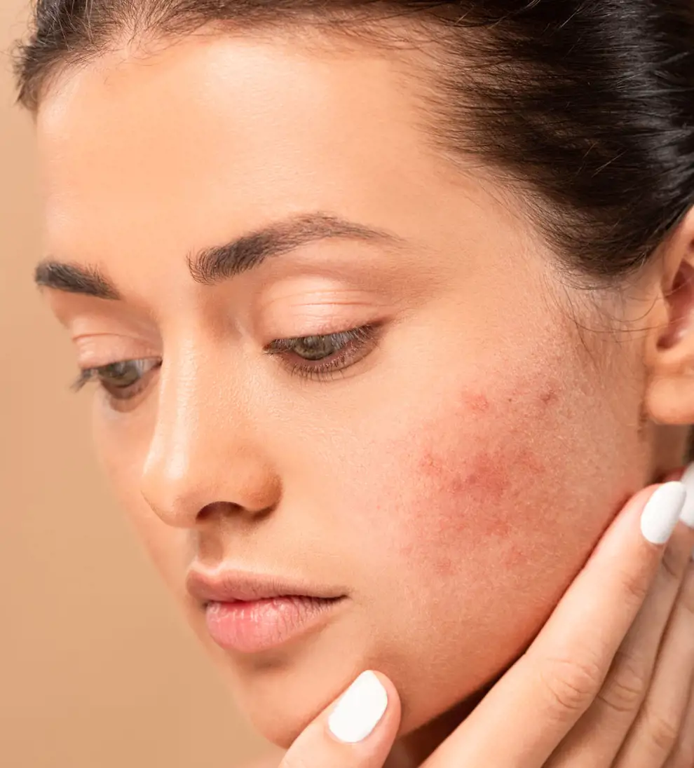 ¿Cómo hidratar la piel grasa de la cara?